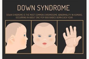 Memahami dan Peduli pada Down Syndrome
